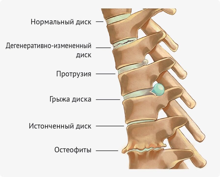 Lumbar osteochondrosisaren disko deformazioak
