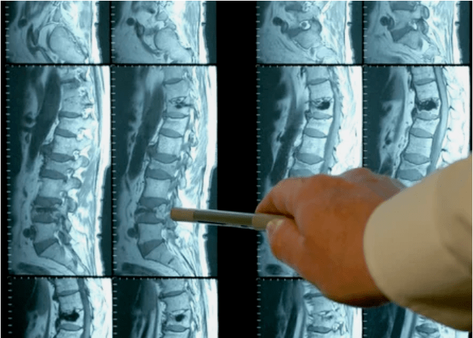 Bizkarrezurrean osteokondrosiaren barietateak