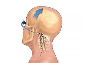 Bizkarrezurreko bizkarrezurraren osteochondrosak nola manifestatzen du