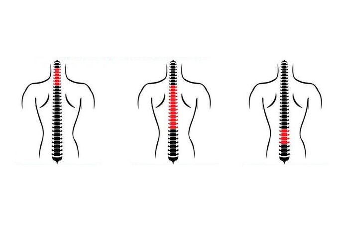 Nola agertzen da osteokondrosia